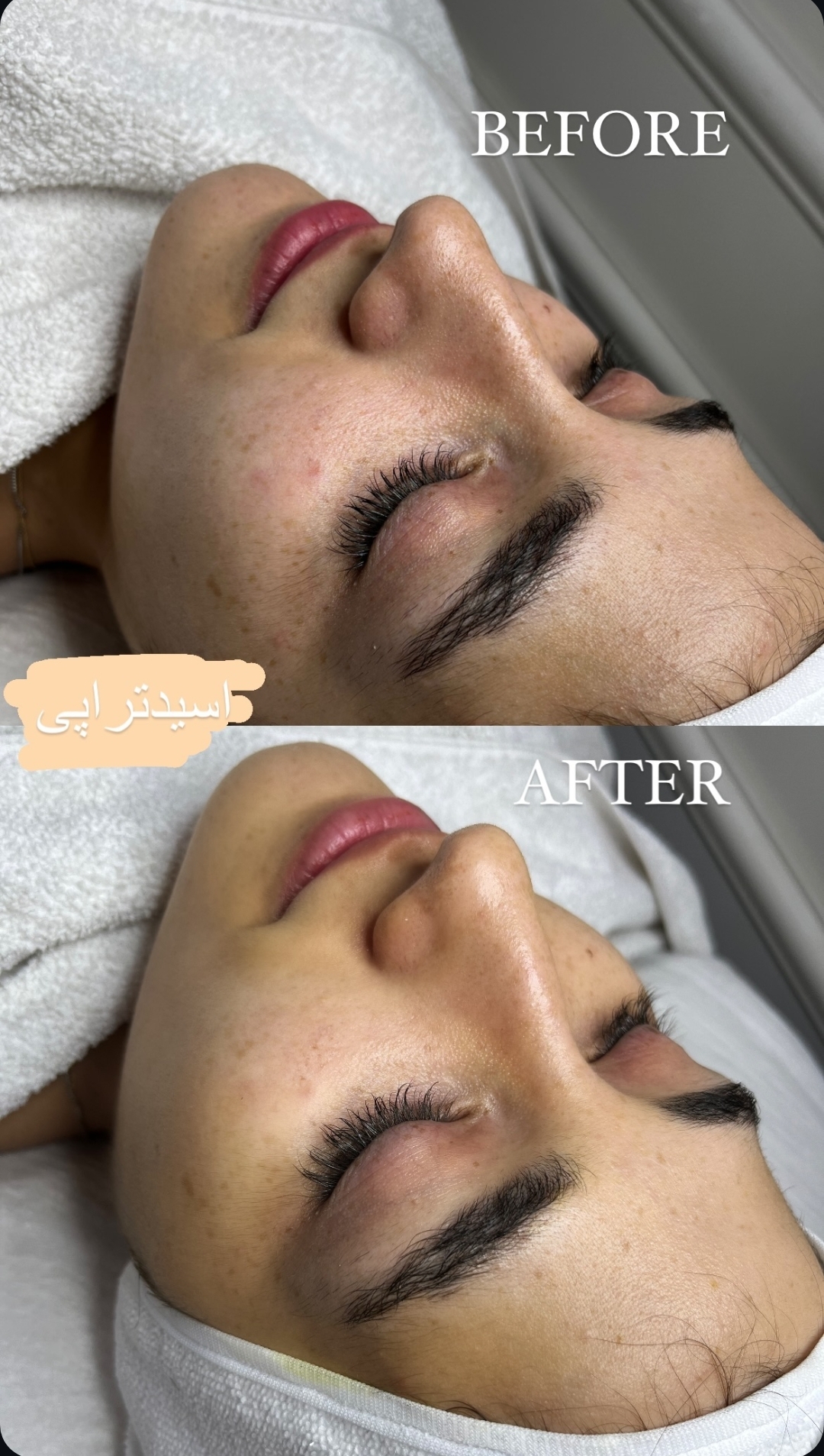 اسید تراپی